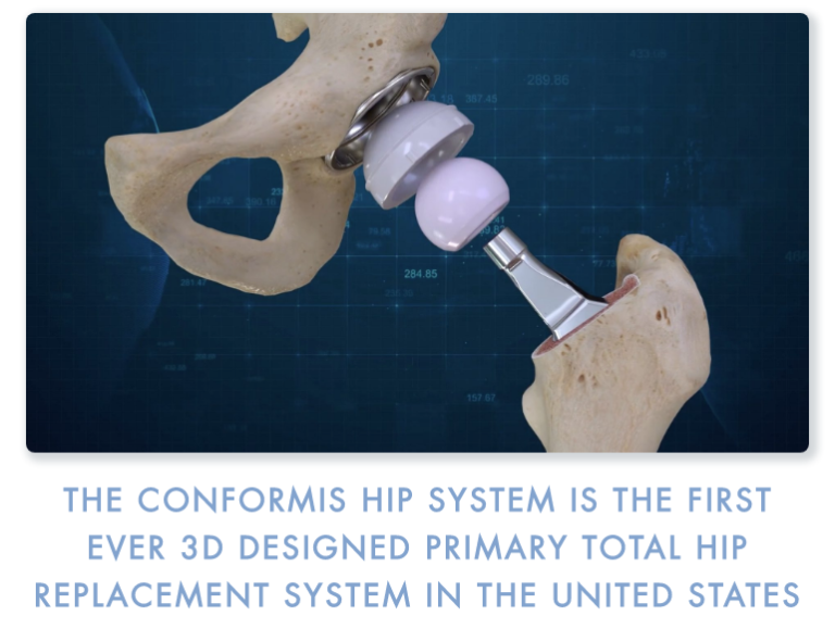 Conformis Hip System Conformis